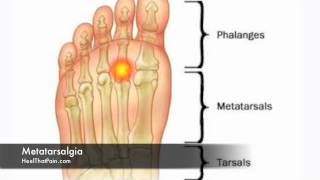 Metatarsalgia Foot Pain Causes Symptoms amp Treatments [upl. by Ronacin]